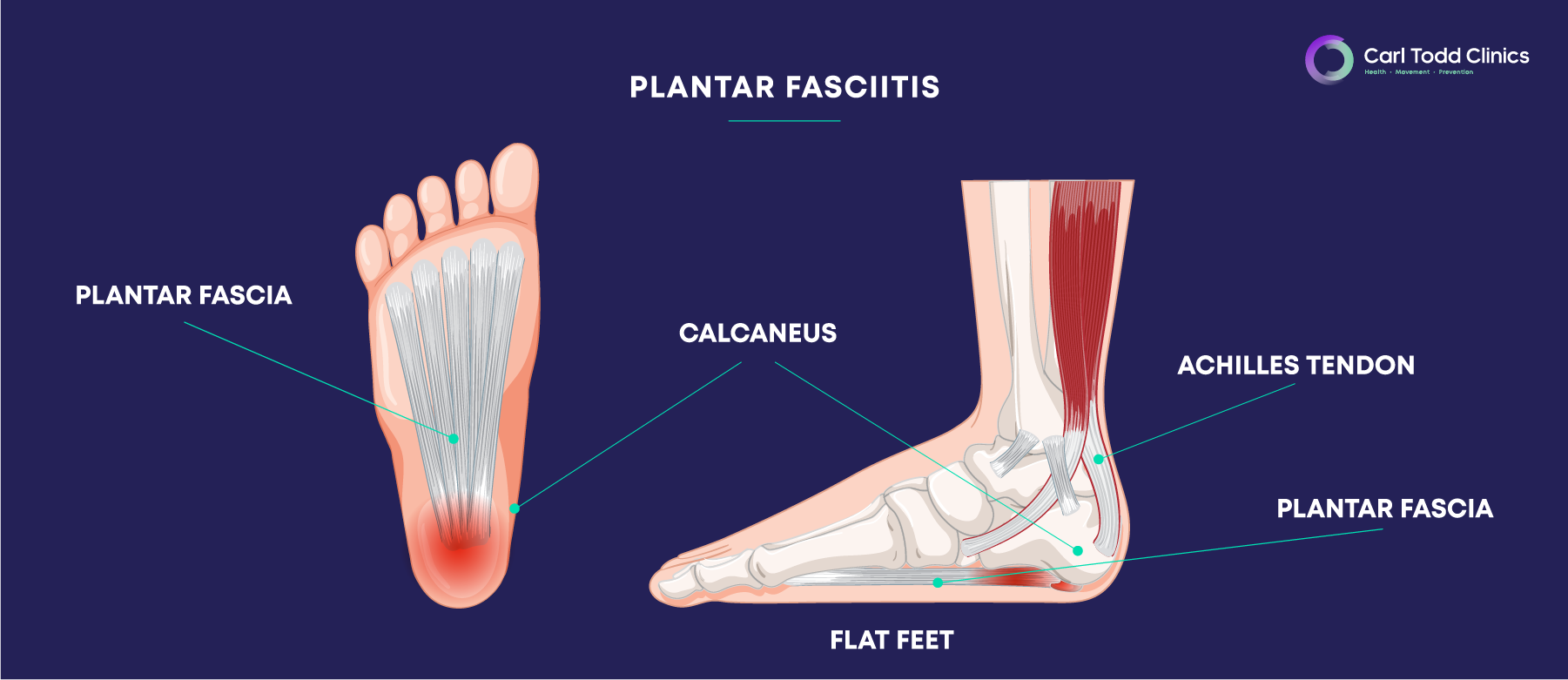 diagram of a foot depicting Plantar Fasciitis