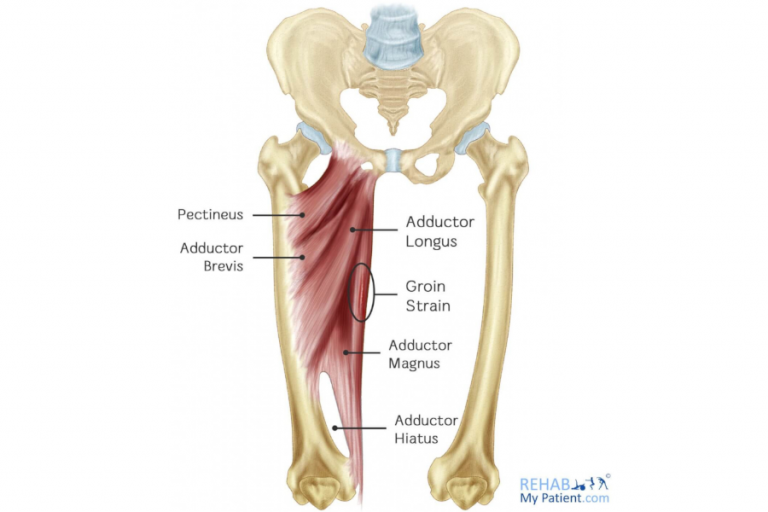 How to speed up recovery from a groin strain - Carl Todd Clinic