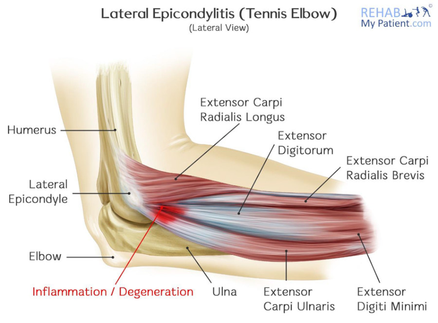 Tennis elbow diagram