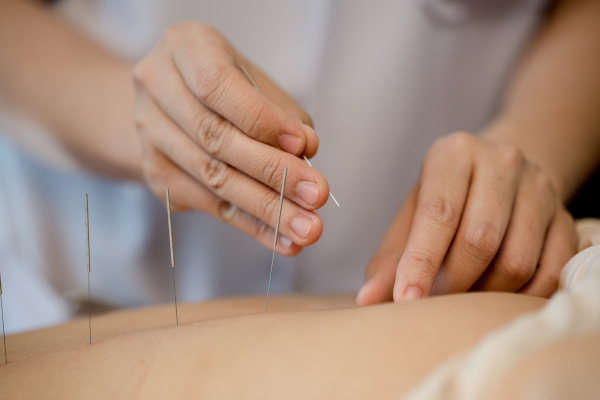 Acupuncture for the menopause