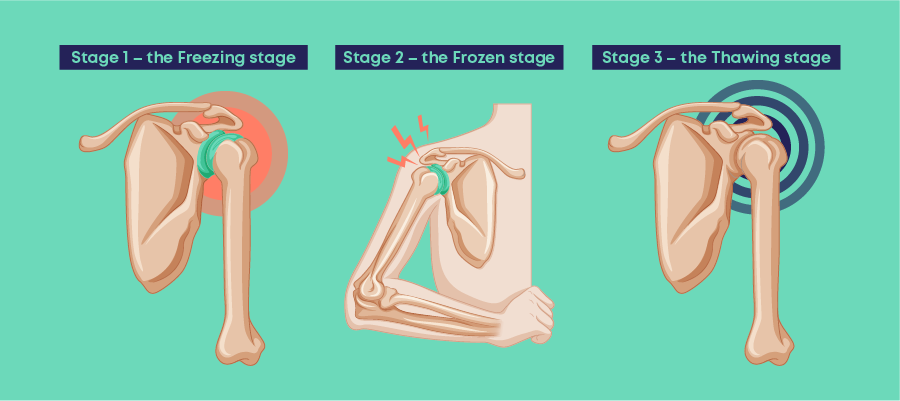 new research on frozen shoulder