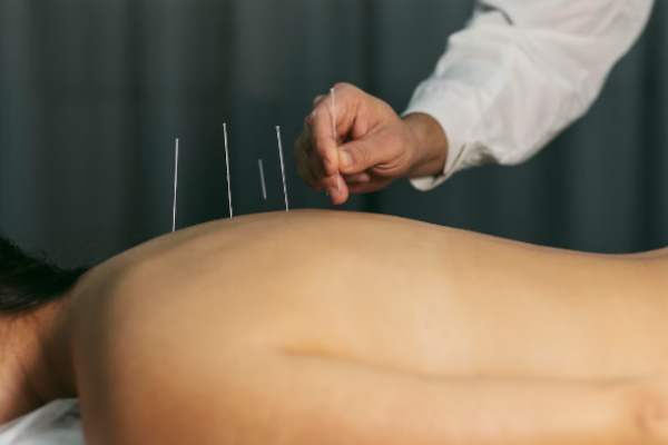 Dry needling and traditional acupuncture banner