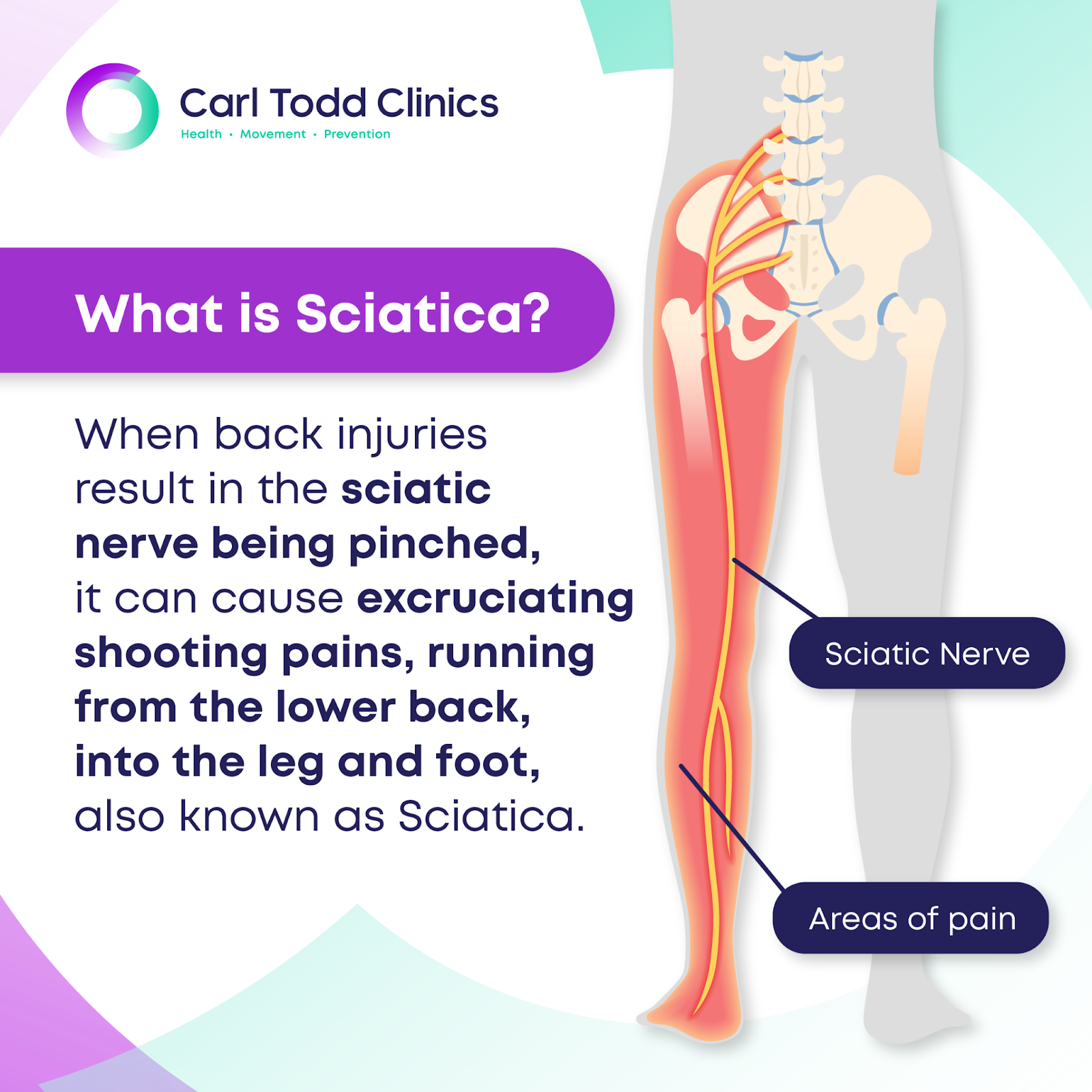 what is sciatica